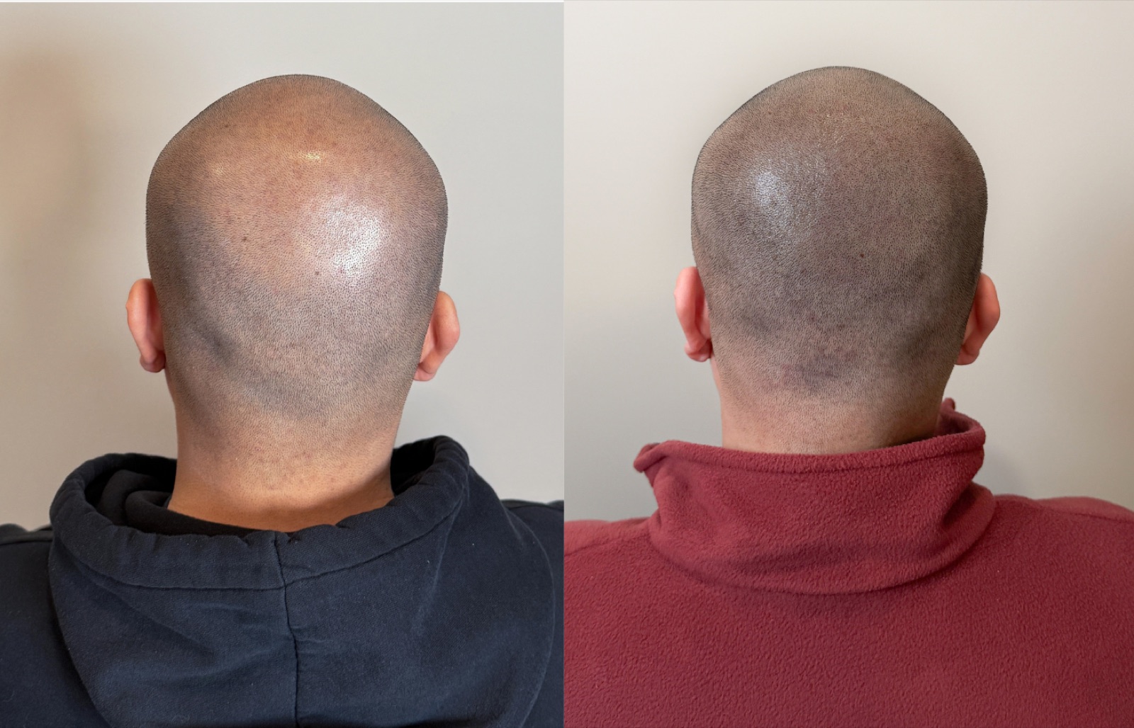Shaved look SMP portfolio 26